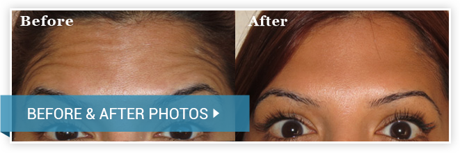 Fillers/Botox. Before and After Procedure. photos female front view