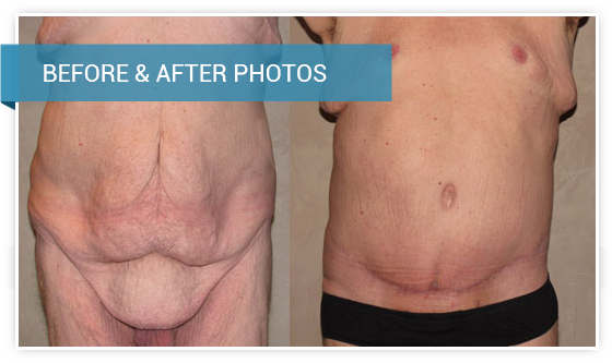 Supplies for Body Contour Surgery: Abdominoplasty, Body Lift