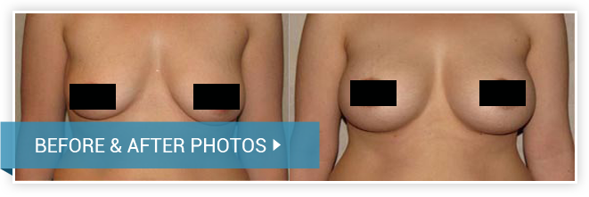Breast lift (Mastopexy). Before and After photos. Woman - front view