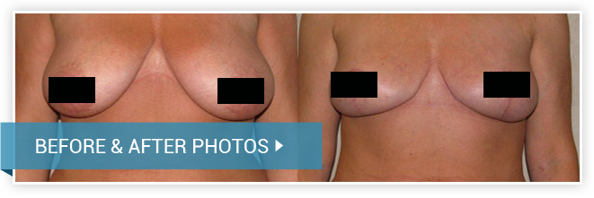 Breast Reduction. Before and After photos. Female - front view