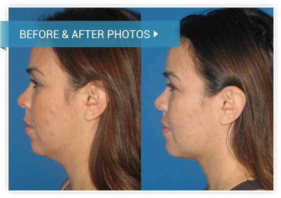Chin Augmentation. Before and After photos female left side view