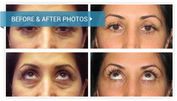 Eyelid Surgery (Blepharoplasty). Before and After photos female front view