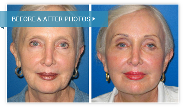 Facelift. Before and After photos female front view