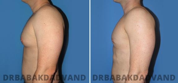 Before and After Photos. Gynecomastia. 2