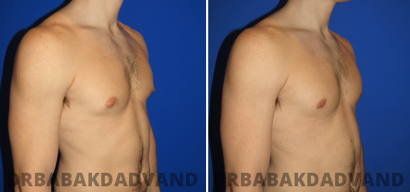 Before and After Photos. Gynecomastia. 5