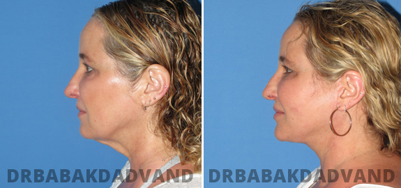 Before and After Photos. Facelift. 2