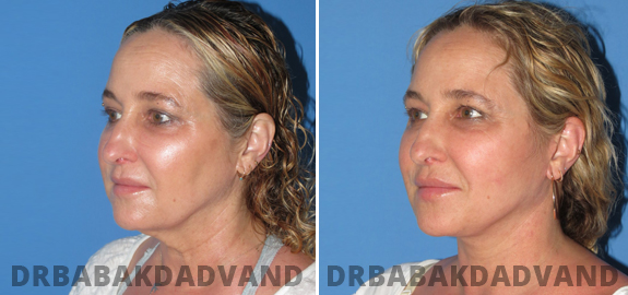  Before and After Photos. Facelift. 3