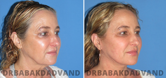 Before and After Photos. Facelift. 5