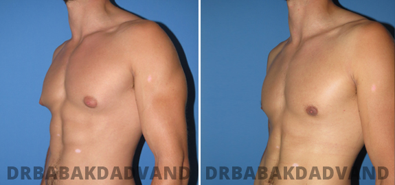  Before and After Photos. Gynecomastia. 3
