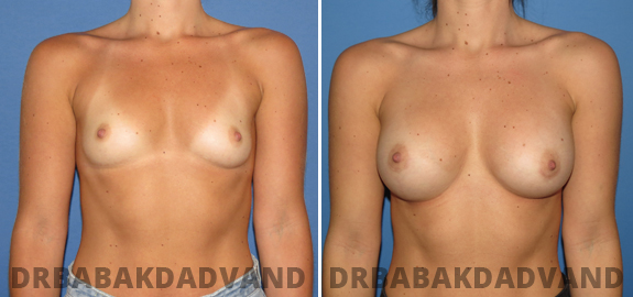 Breast Augmentation. Before and After Photos.