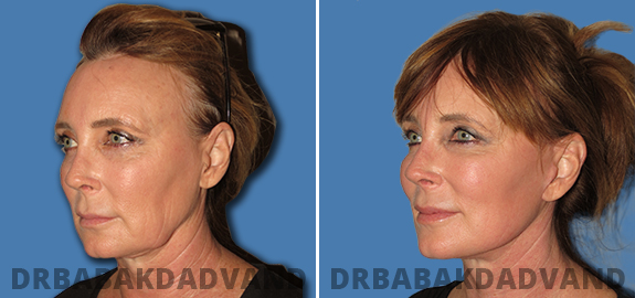 Before and After Photos. Facelift img-3