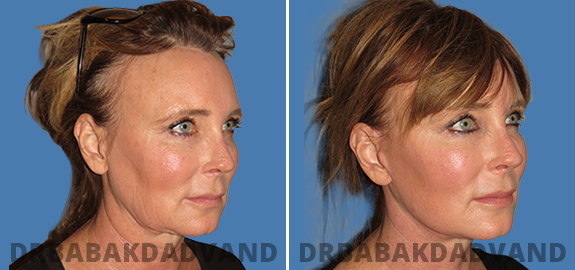 Before and After Photos. Facelift img-5