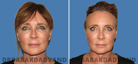 Facelift: Before and After Photos