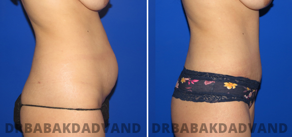 Before & After Photos |Tummy Tuck