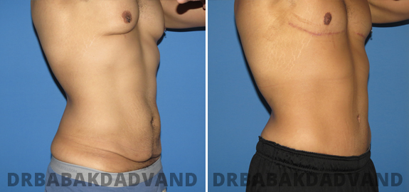 Before & After Photos |Tummy Tuck