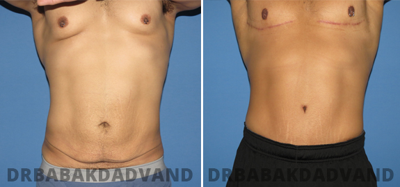 Tummy Tuck: Before & After Photos.