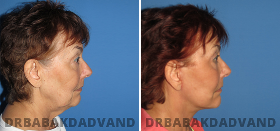 Before and After Photos. Facelift img-4