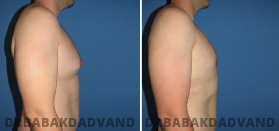 Before and After Photos. Adult_Gynecomastia img-2