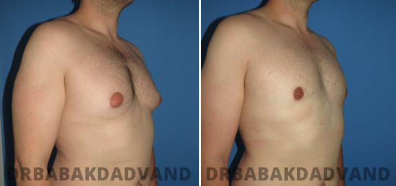 Before and After Photos. Adult_Gynecomastia img-3