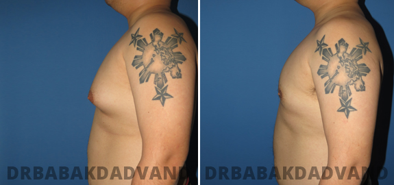Before and After Photos. Adult_Gynecomastia img-2