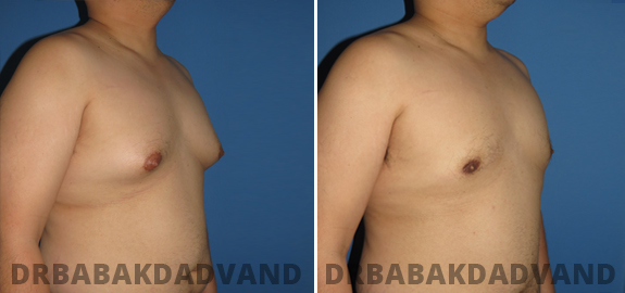 Before and After Photos. Adult_Gynecomastia img-5