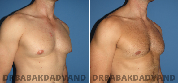 Before and After Photos. Adult_Gynecomastia img-4