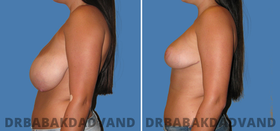 Before and After Photos. Breast-Reduction. 2