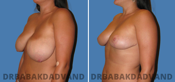  Before and After Photos. Breast-Reduction. 3
