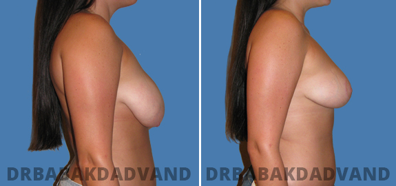 Before and After Photos. Breast-Reduction. 4