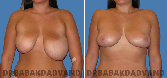 Before and After Photos. Breast-Reduction. 1