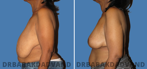 Before and After Photos. Breast-Reduction img-2