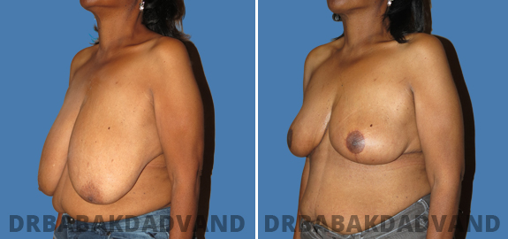 Before and After Photos. Breast-Reduction img-3