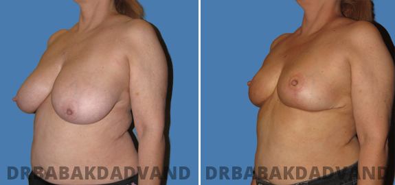 Before and After Photos. Breast-Reduction img-2