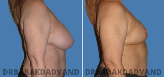 Before and After Photos. Breast-Reduction img-3