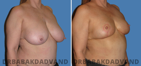 Before and After Photos. Breast-Reduction img-4