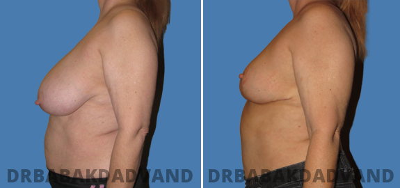 Before and After Photos. Breast-Reduction img-5