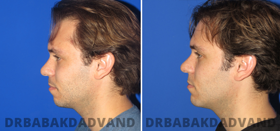Before and After Photos. Chin Augmentation img-2