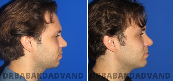 Before and After Photos. Chin Augmentation img-4