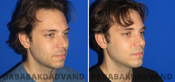 Before and After Photos. Chin Augmentation img-5