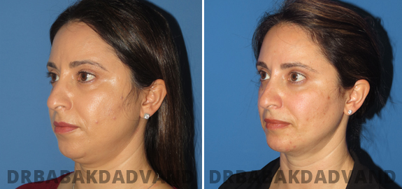 Before and After Photos. Chin Augmentation img-3