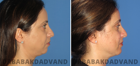 Before and After Photos. Chin Augmentation img-4