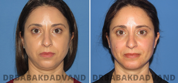 Before and After Photos. Chin Augmentation img-1