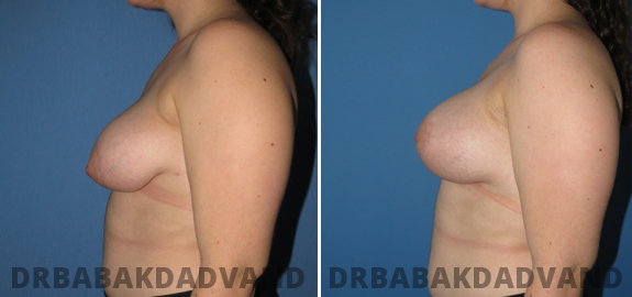 Before and After Photos. Breast Lif img-2