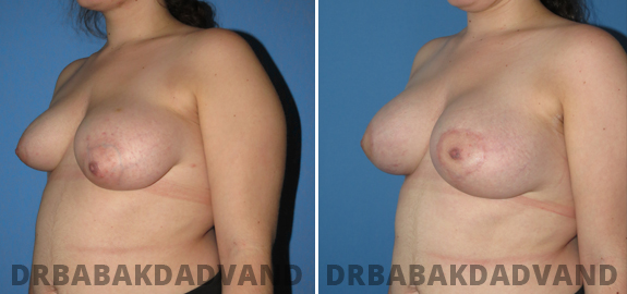 Before and After Photos. Breast Lif img-3