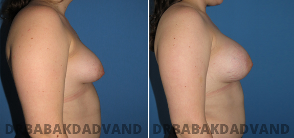 Before and After Photos. Breast Lif img-4