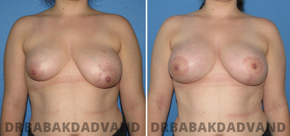 Breast Lift. Before and After Photos.