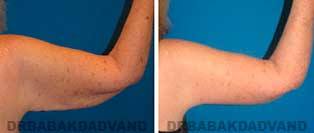 Body Before & After Photos: Brachioplasty