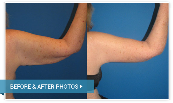 A before and after view of a successful brachioplasty procedure. An untoned  arm is seen on