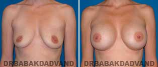 Breast Augmentation. Before & After Photos. 40 year old female frontal view