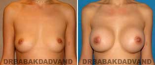 Breast Augmentation. Before & After Photos. 29 year old female frontal view